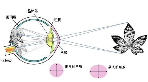 忽略散光真的伤不起