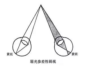 矫正屈光参差的方法及5种不同情况的配镜原则