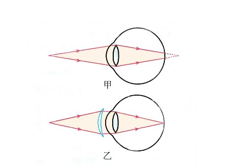远视眼镜是什么镜?矫正原理是什么?如何选择远视眼镜?